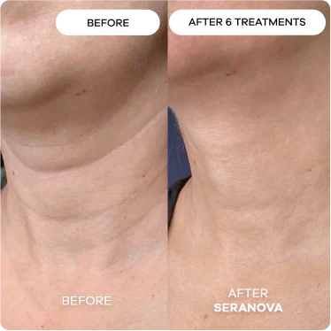 Before and after for crows feet